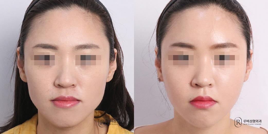 Face Fat Graft