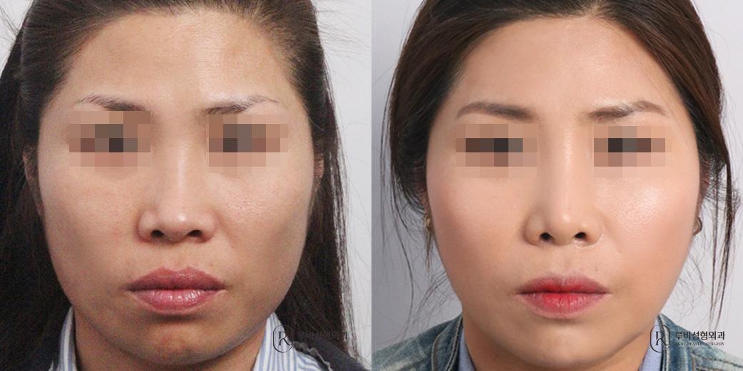 Face Fat Graft