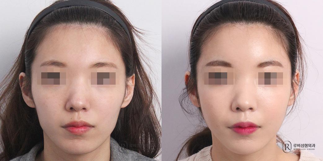 Face Fat Graft
