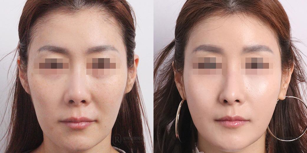 Face Fat Graft