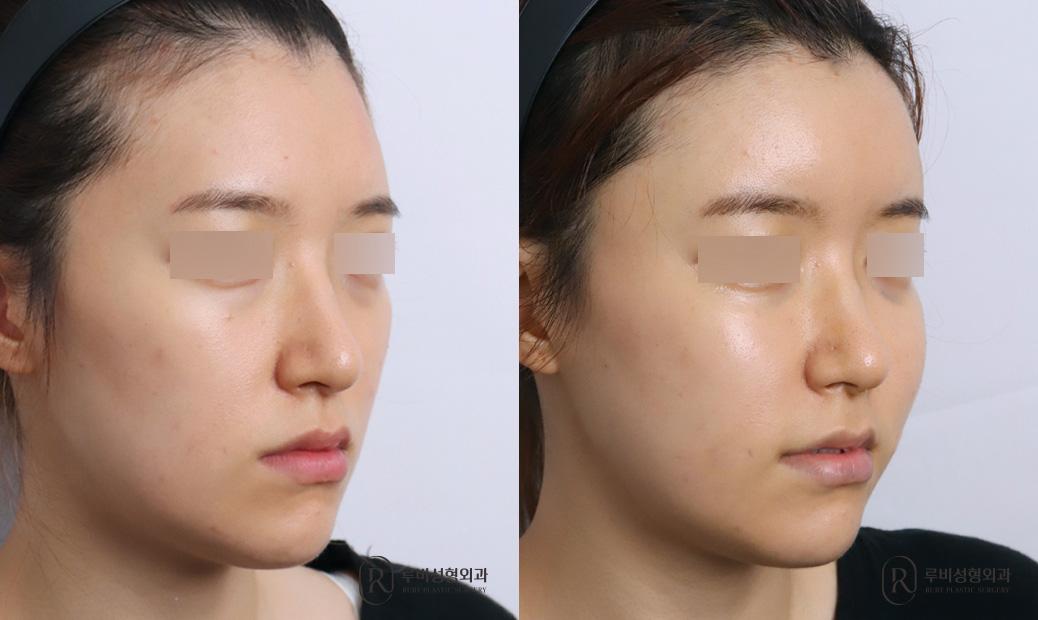 Face Fat Graft