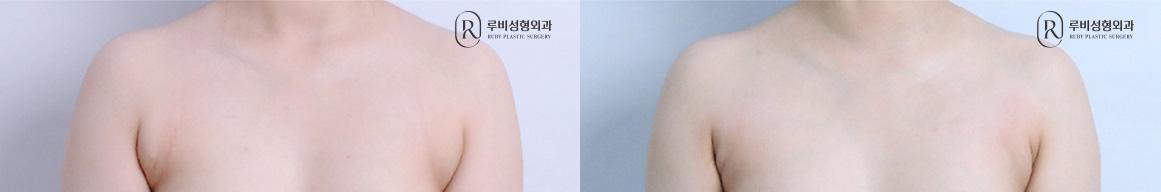 Accessory Breast Tissue Liposuction