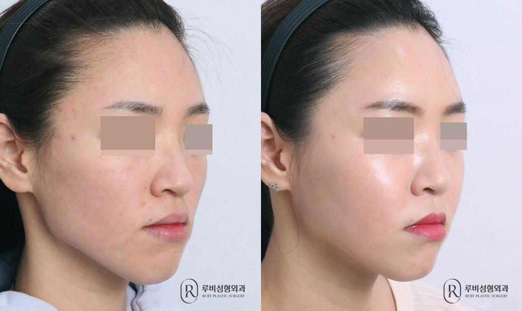 Face Fat Graft