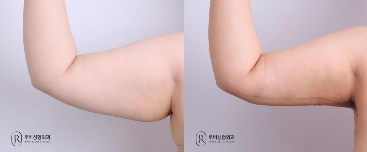 Arm Liposuction