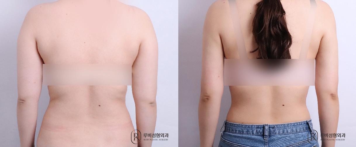 Arm Liposuction