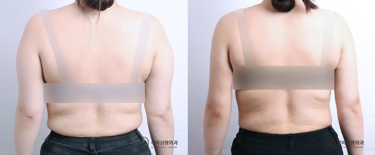 Arm Liposuction
