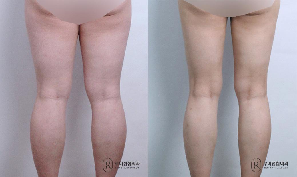 Thigh Liposuction