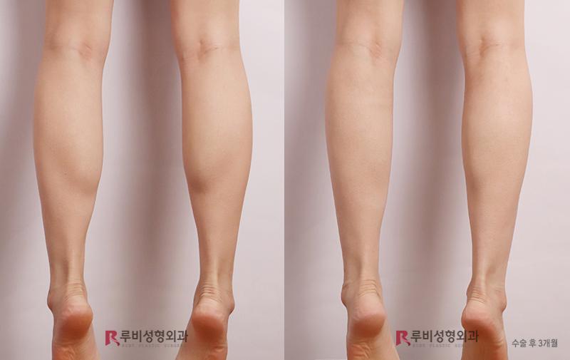 Calf contouring (selective nerve block)