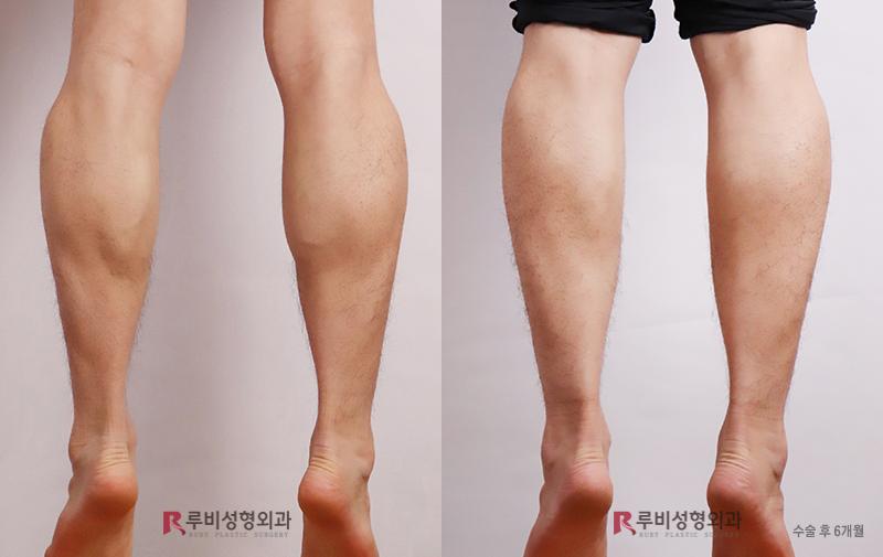 Male Calf Reduction (Selective Nerve Block)