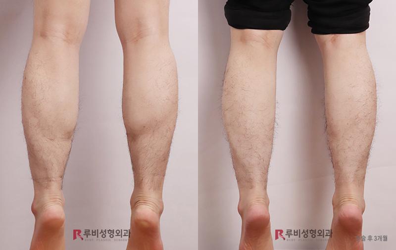 Male Calf Reduction (Selective Nerve Block)