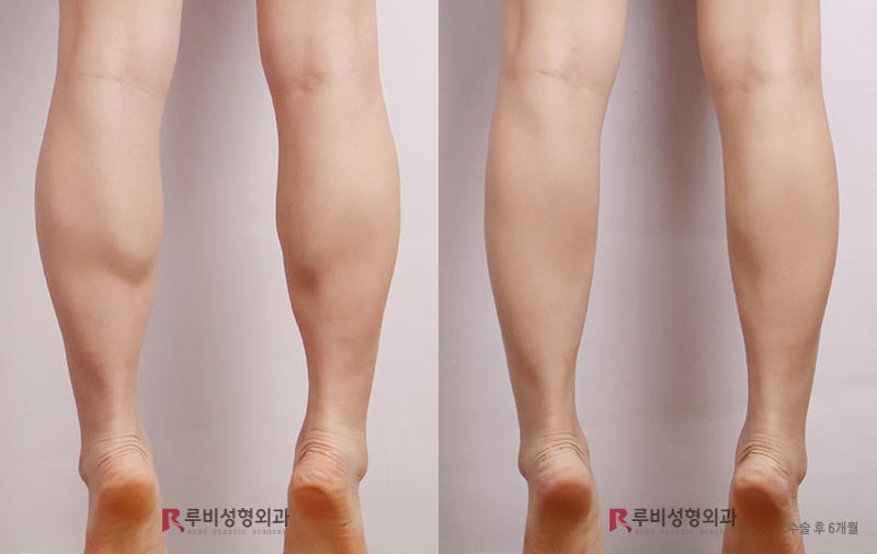 Calf contouring (selective nerve block)