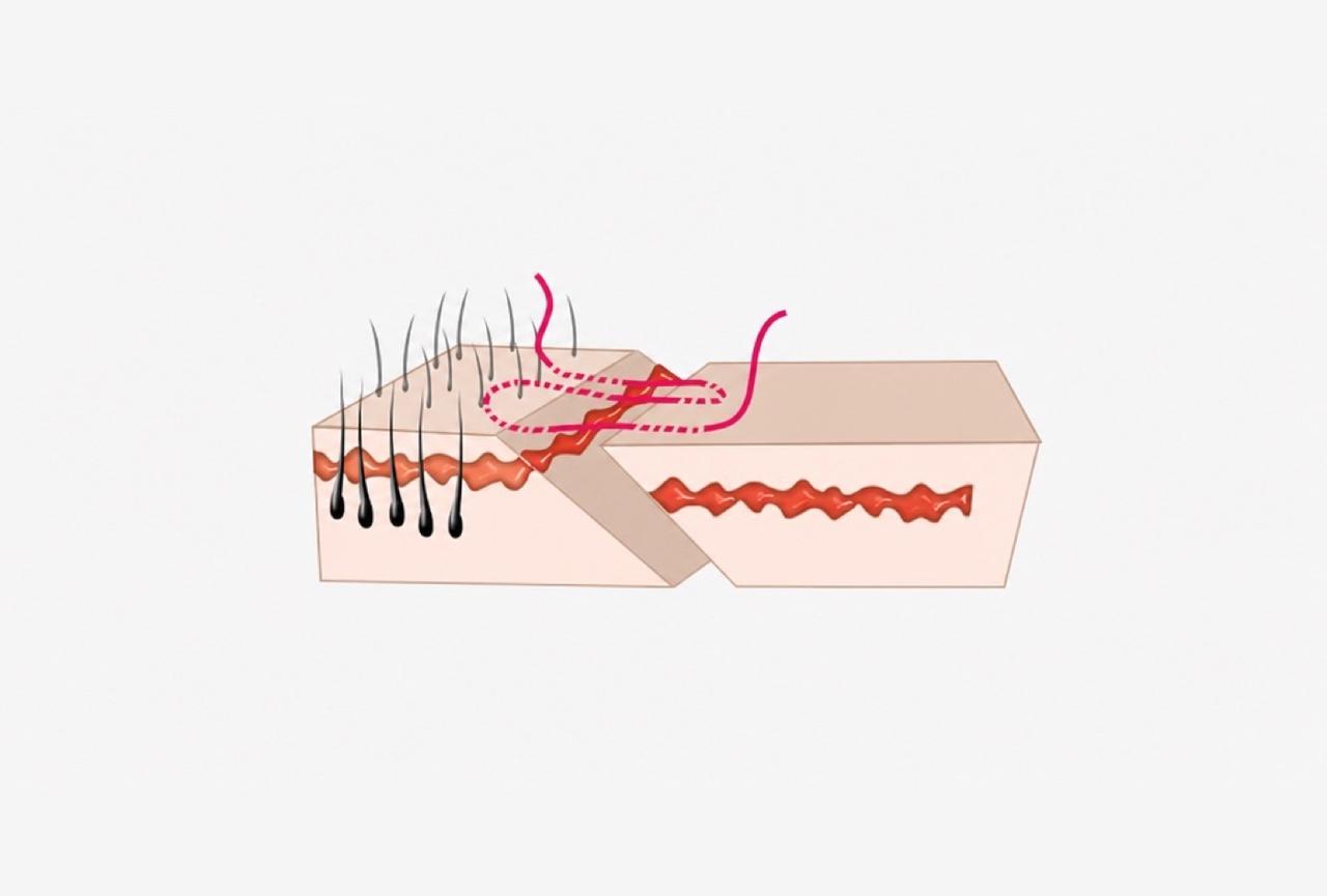 45-degree incision and suturing