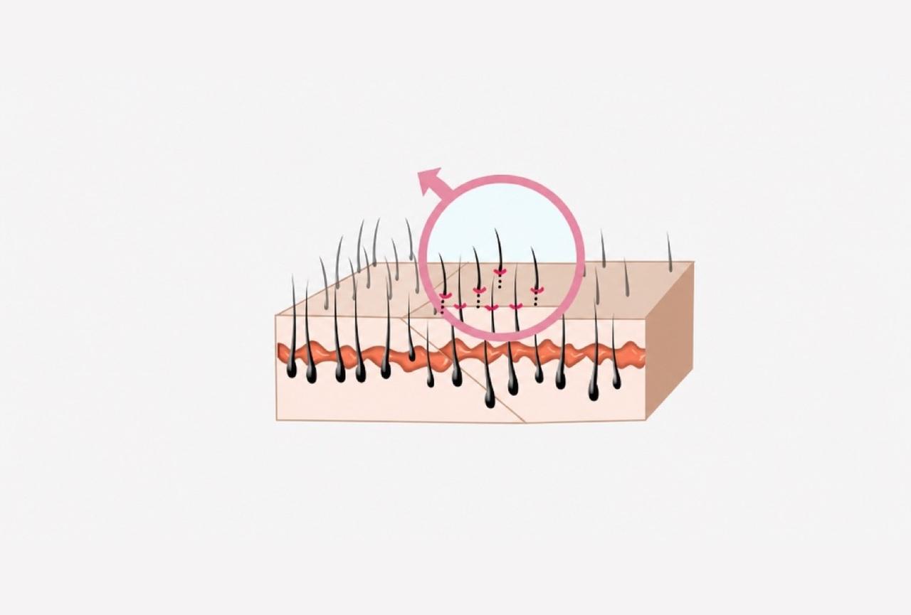 Hair root preservation after suturing