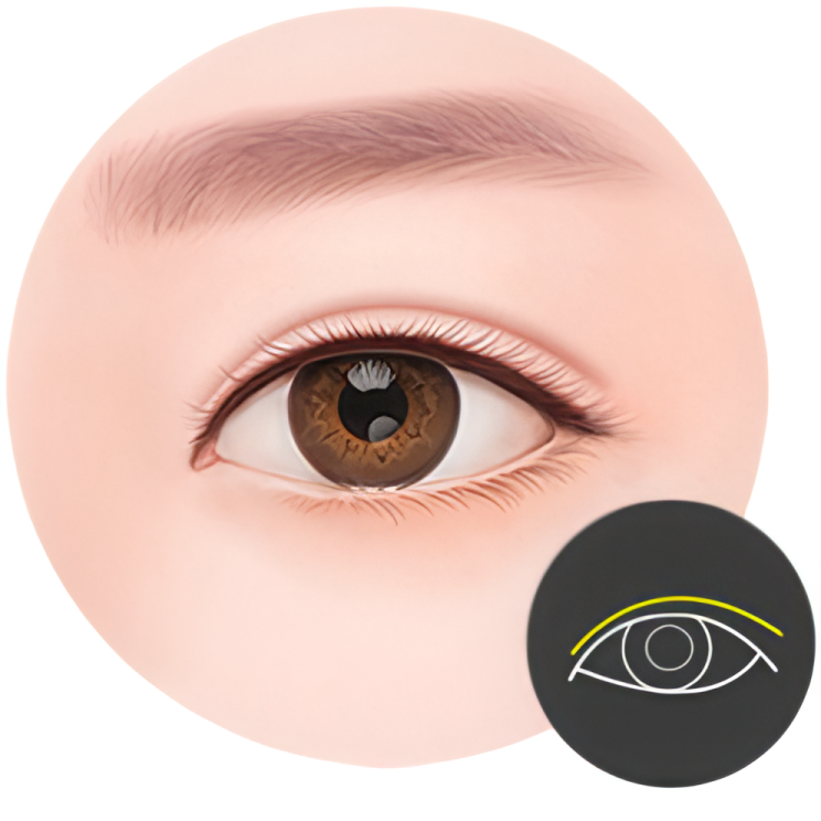 인아웃라인 쌍꺼풀