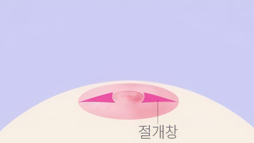 유두의 양쪽을 절개합니다.